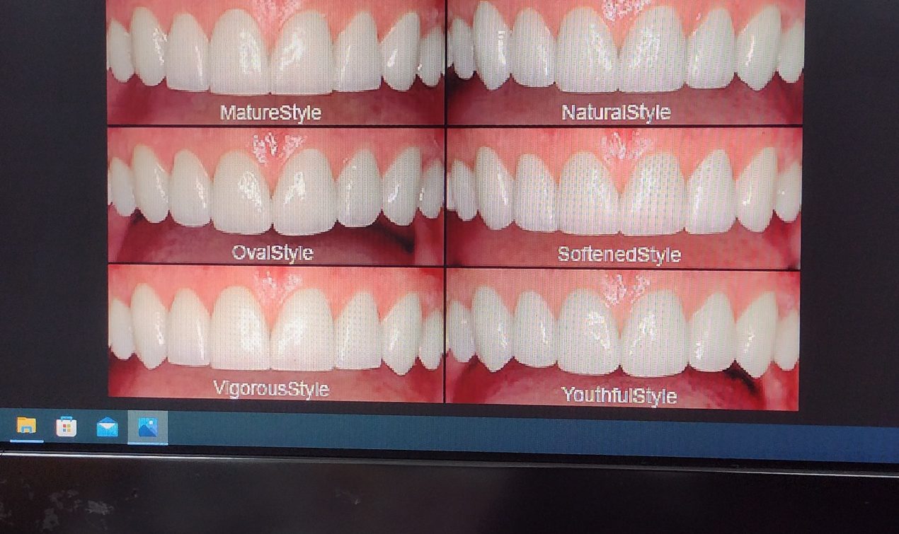 the different smile options to choose from during the dental tourism smile makeover.
